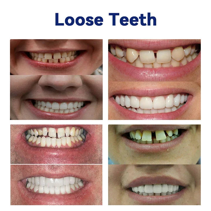 SmileFitPro™-New Generation Flexible Full Denture Solution