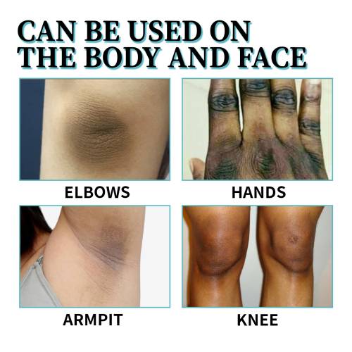 Urea & Lactic Acid Body Lotion for Dark, Rough Areas