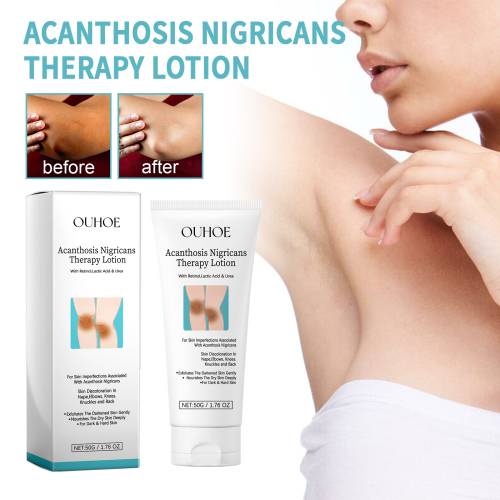 Urea & Lactic Acid Body Lotion for Dark, Rough Areas
