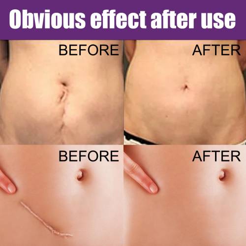 Silicone Gel Skin Patches