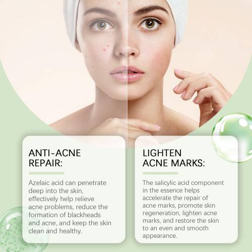 Azelaic Acid Face Essence for Blackheads
