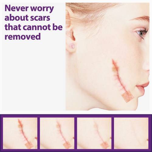 Silicone Gel Skin Patches