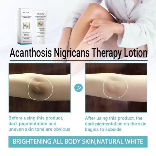 Urea & Lactic Acid Body Lotion for Dark, Rough Areas