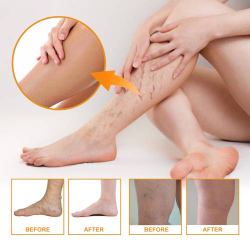 Leg Massage Cream with Vitamin K