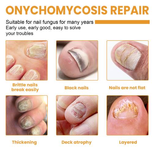 Overnight Nail Patches with Garlic