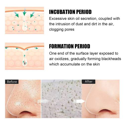 Blackhead Removal Nose Mask with Green Tea