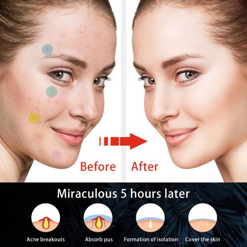 Colourful Hydrocolloid Pimple Patches