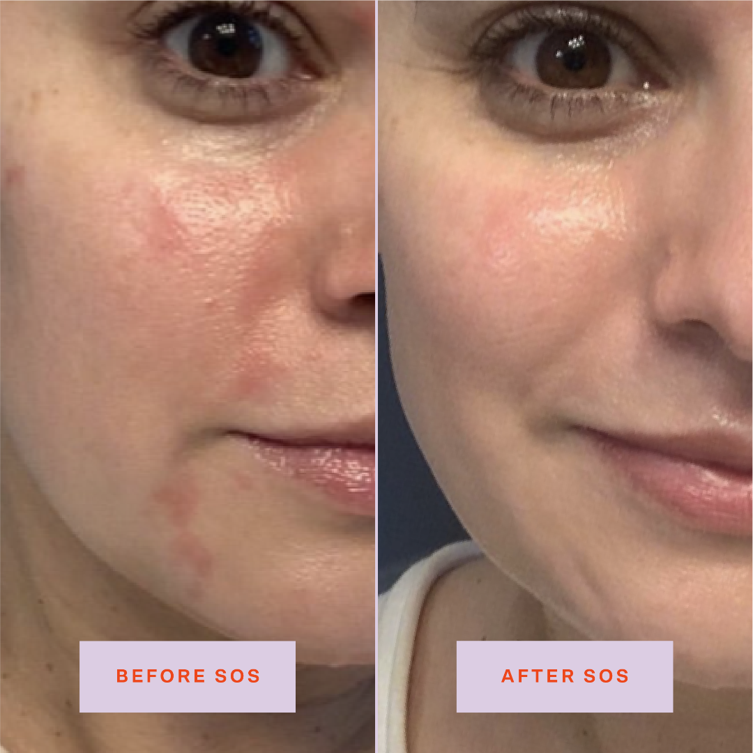 SOS Rescue Spray Hypochlorous Acid Facial Spray for Breakouts