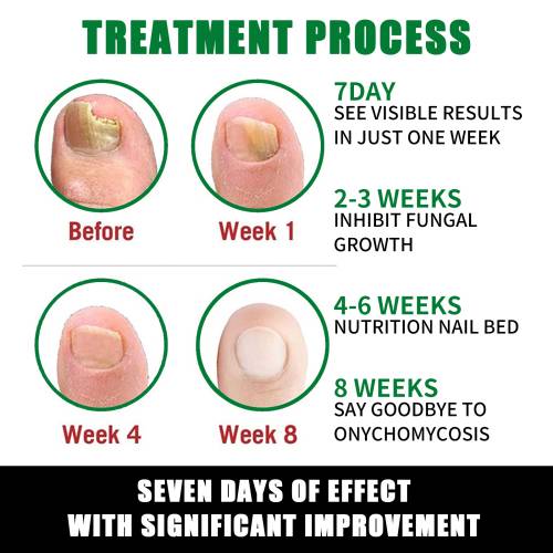 Ginger Nail Care Solution