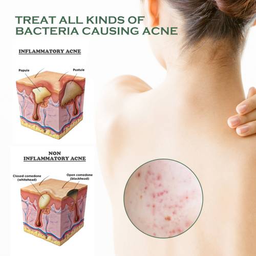 Back & Body Clarifying Spray with Witch Hazel