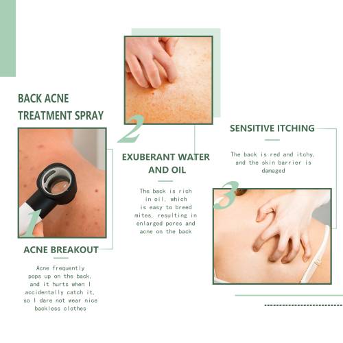 Back & Body Clarifying Spray with Witch Hazel