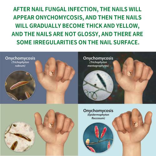 Ginger Nail Care Solution